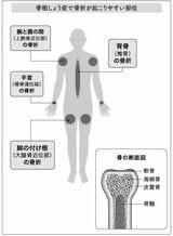 骨粗しょう症で骨折が起こりやすい部位