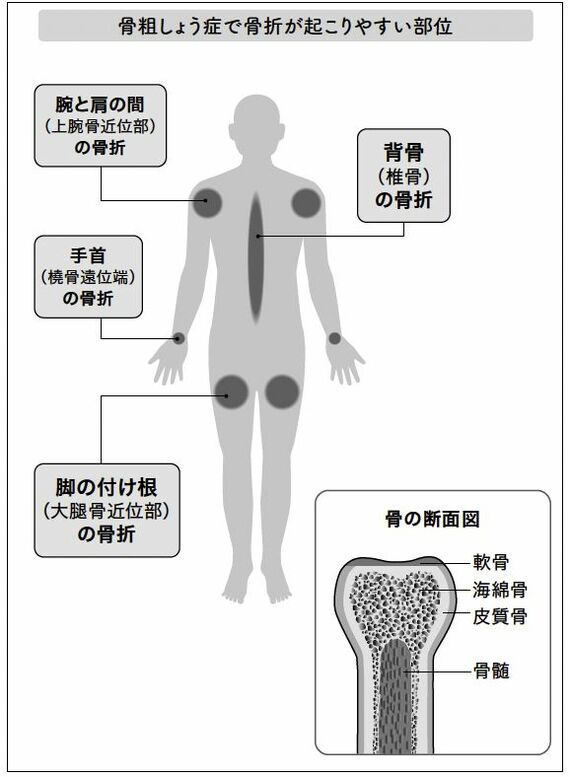 骨粗しょう症で骨折が起こりやすい部位