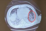 コロナ重症患者の肺のCT画像。囲んだ部分がすりガラス状になっている