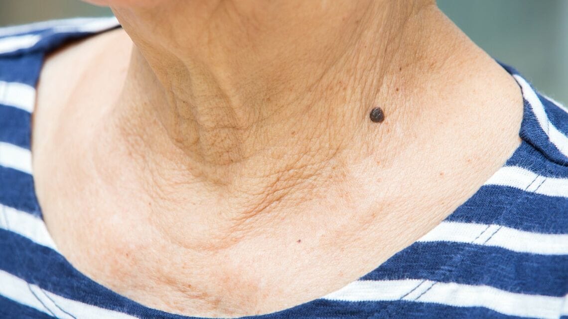 悪いホクロの見分け方とは（写真：eyepark／PIXTA）