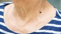 ｢ホクロが肥大化｣する皮膚がん､4つの見分け方 大人になってできたホクロが大きくなると注意