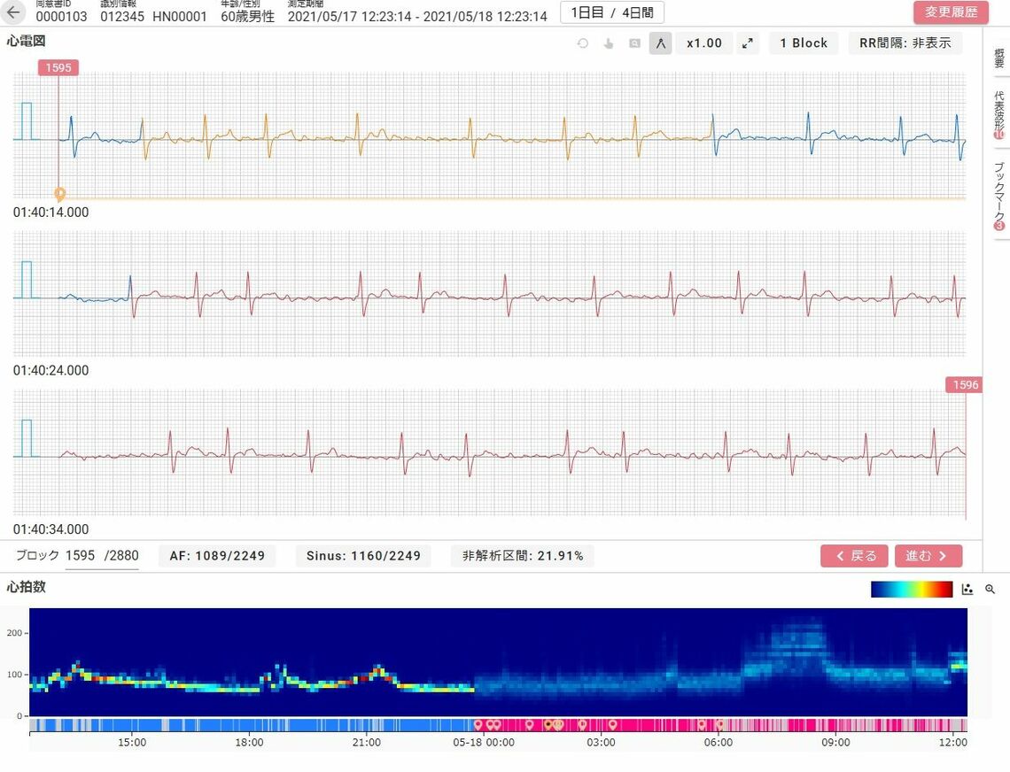 カルディオインテリジェンス社が開発・販売する、長時間心電図解析ソフトウェア『SmartRobin AI シリーズ』