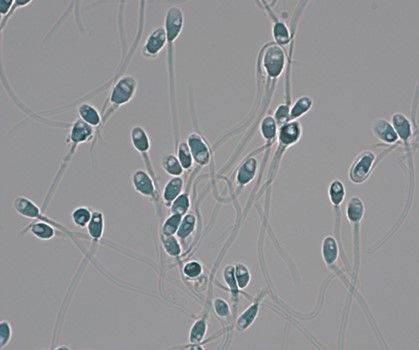 一見良好に見える運動精子でも、精子の中の見えない部分に 空胞（穴）が認められる隠れた異常をもつ精子もたくさんある（写真：黒田インターナショナルメディカルリプロダクション）