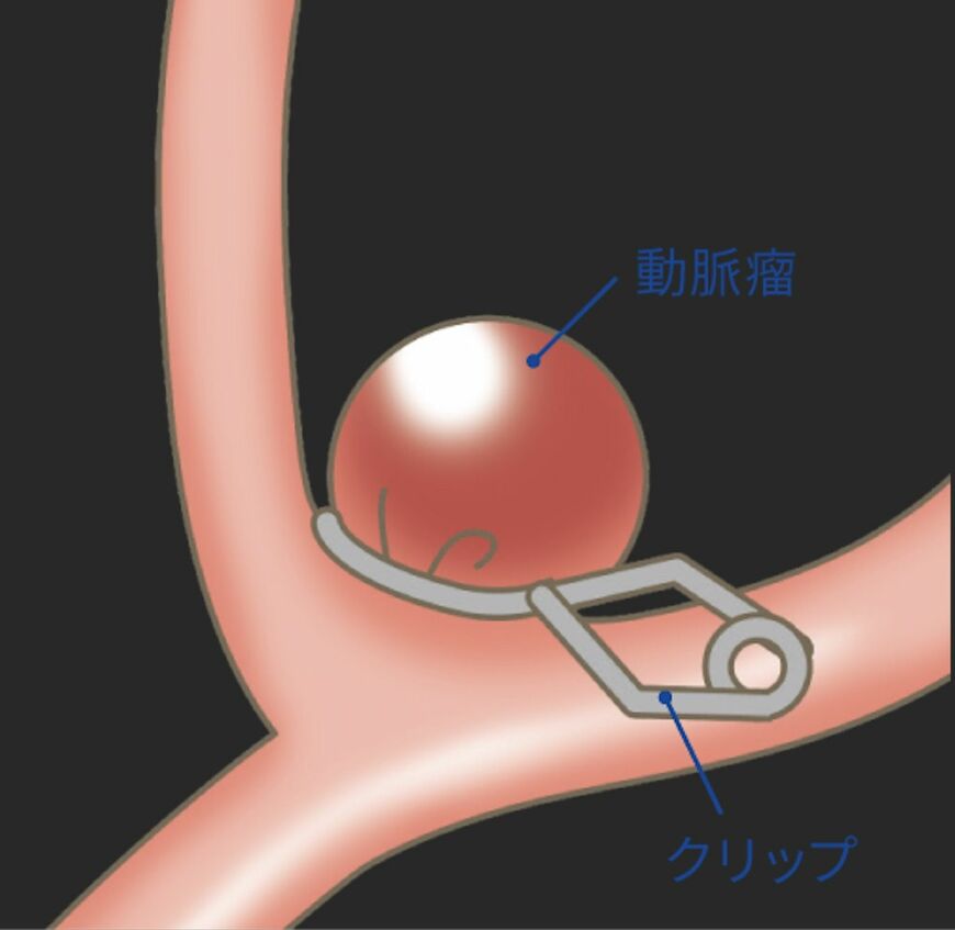 クリッピング術イメージ（画像：メドトロニック）