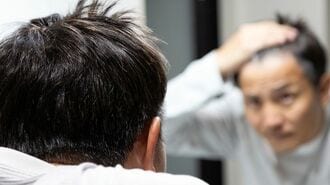 自分の細胞使って｢髪の毛取り戻す｣最新薄毛治療