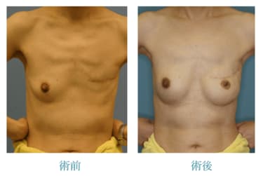 乳房全摘手術から2年。手術痕の今 | 浸潤性乳がん・・・手術のち