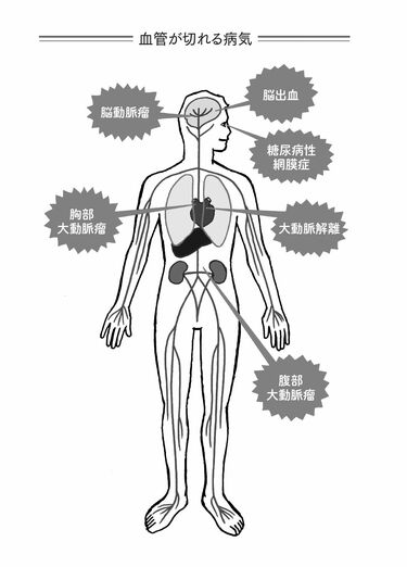西田敏行さんも…」日本で年間10万人いる“ピンコロリ（突然死）”の裏に