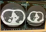 3カ月で腫瘍は明らかに縮小していた（筆者撮影）