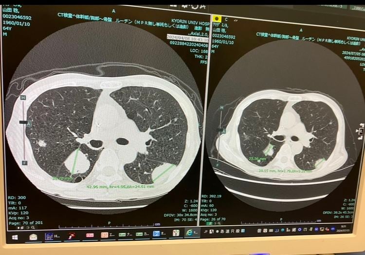 治療の第1弾である全身化学療法「GCarbo療法」では、3カ月で腫瘍は明らかに縮小したのだが…（筆者撮影）