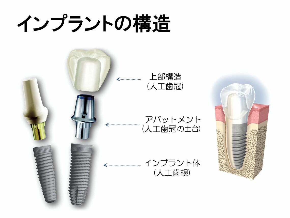 インプラントの構造