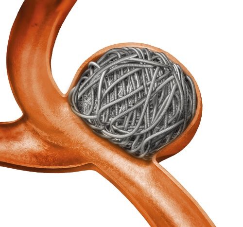 コイル塞栓術イメージ（画像：メドトロニック）