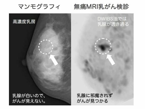 マンモグラフィと無痛MRI乳がん検診の画像の違い
