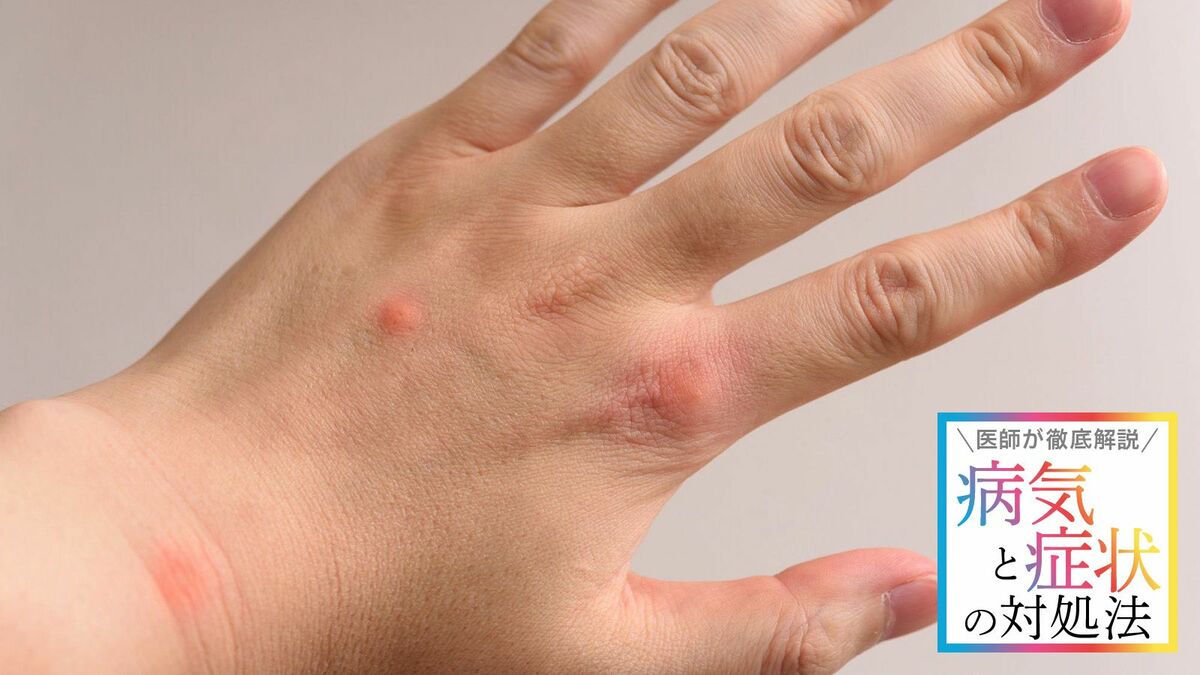 無毒のクモに刺された場合の治療法