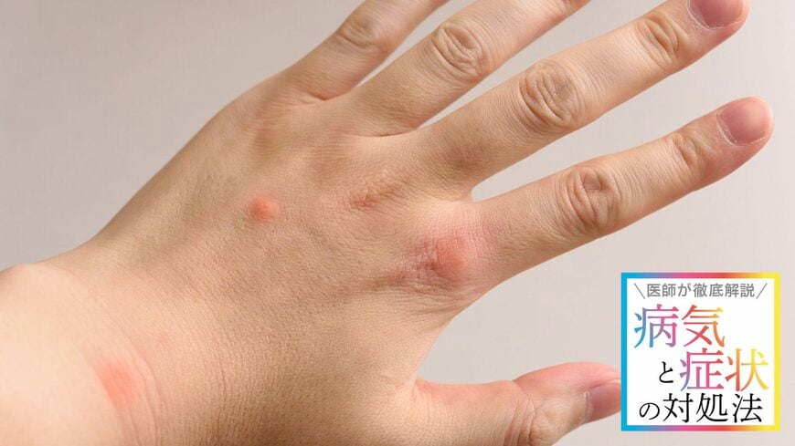 虫やダニに刺されたときの対処法を解説します（写真：Graphs／PIXTA）
