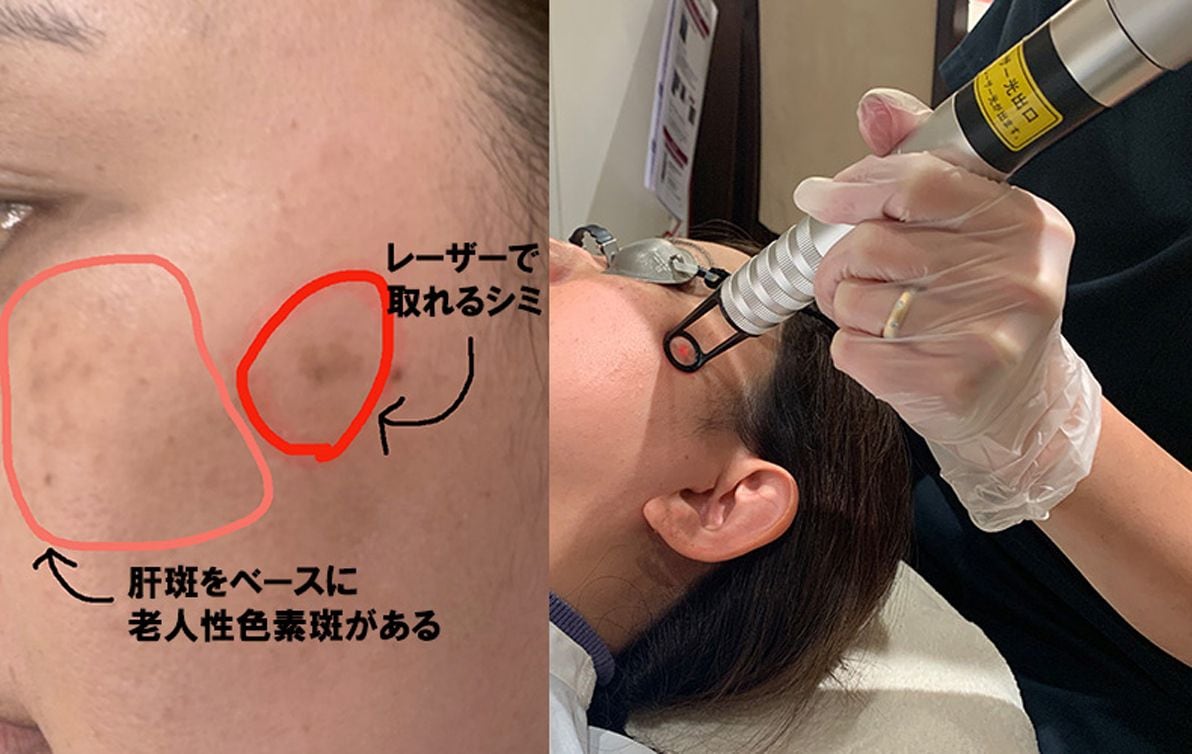 シミ取り｣をやりたくなるマスク生活の必然 レーザー治療をやってみた