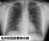 8月5日、「東京都発熱相談センター」で紹介された病院でのレントゲン写真。まだ肺はキレイだった（写真：取材者提供）