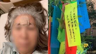 サルコイドーシス　患者　短冊