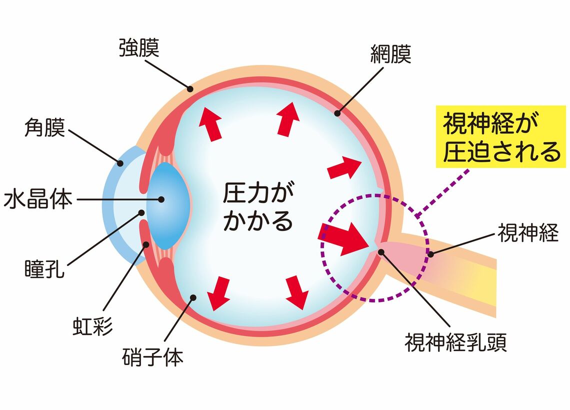 緑内障で視野が欠けるしくみ（イラスト：koti／PIXTA）