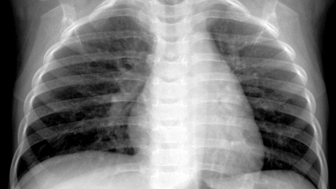 ヒトメタニューモウイルス（hMPV）に感染した生後4カ月の男児のレントゲン（写真：Hilmes et al., Pediatric Radiology, 2017 via The New York Time）