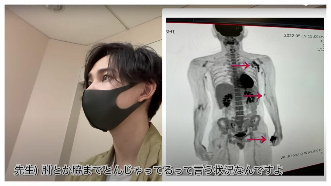 片腕切断