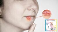 【唇に水ぶくれ】口唇ヘルペス繰り返す根本要因 子供と大人の初感染は､症状も大きく異なる