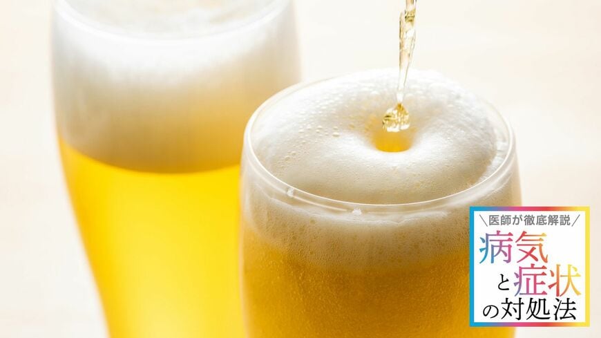 ビールに多く含まれるプリン体は尿酸値を上げ、痛風になるといいますが、プリン体ゼロのビールだから安心と、飲みすぎていいというわけではないようです（写真：kai／PIXTA)