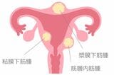 子宮筋腫の種類（写真：しらた／PIXTA）