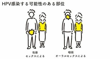 感染が原因｢胃・肝臓・子宮頸部｣のがん徹底予防法 がんとなる手前の