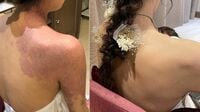 リハビリメイクが蘇らせた素肌と｢魔法の言葉｣ 最愛の娘の半身は赤いアザで覆われていた