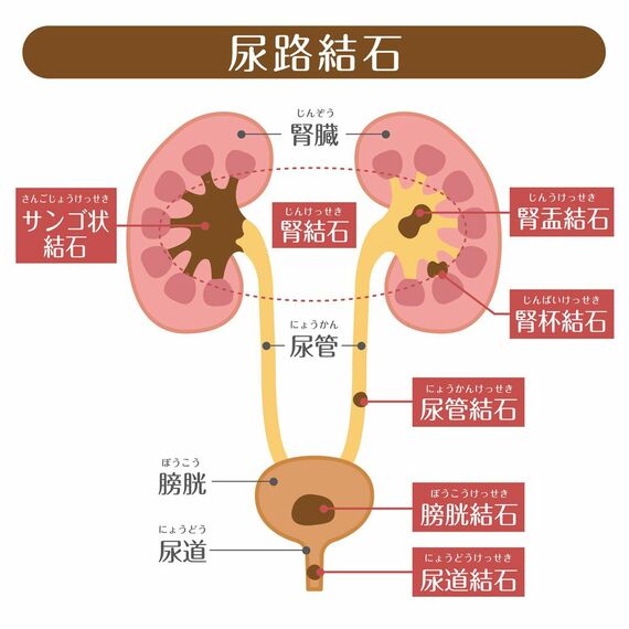 尿路結石