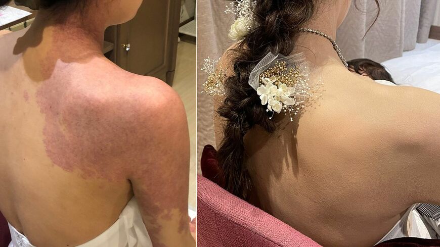 リハビリメイクを受けて結婚式に臨んだ新見有梨沙さん（仮名）。左がメイク前、右がメイク後（写真：REIKO KAZKI）