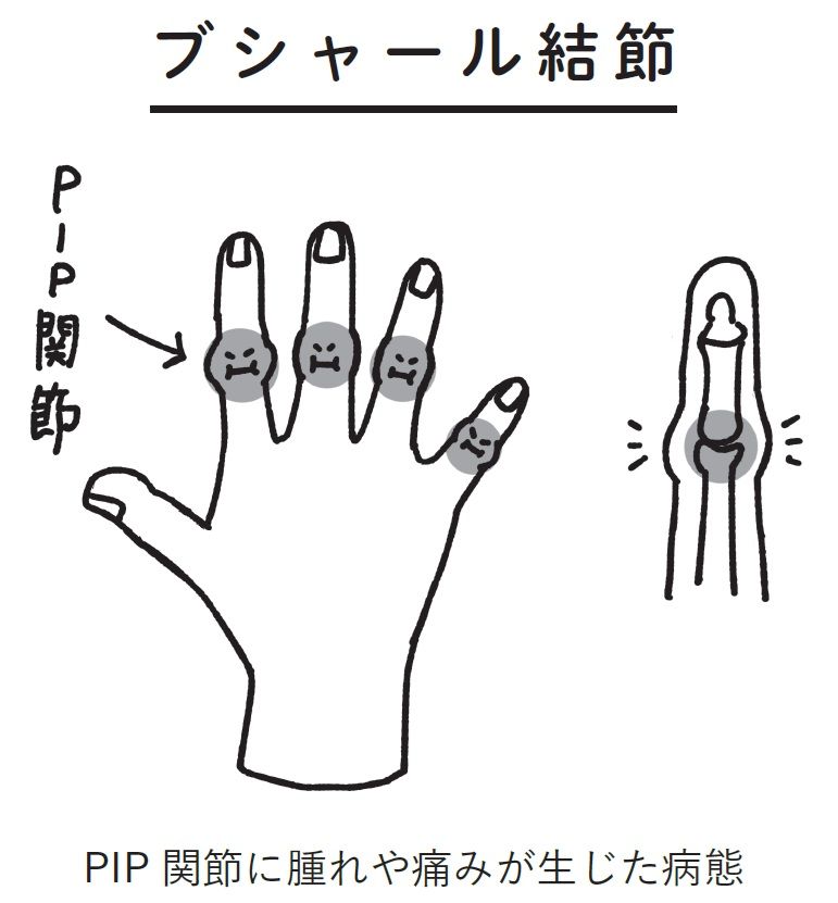 （出所：『自力でできるへバーデン結節のリセット法』より）