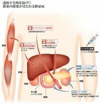 クスリの大図鑑 <糖尿病> 中高年の３分の１が“患者”　完治薬なく新薬に熱視線