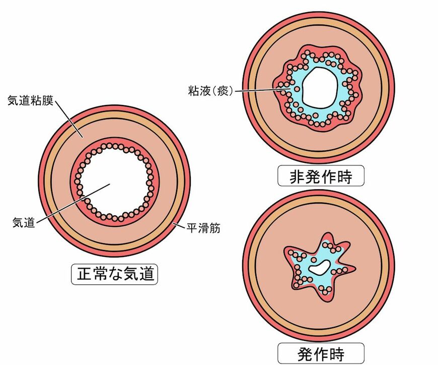 ぜん息患者の気道の断面図（イメージ）＝発作のない時でも正常な人よりは気道が狭い。発作時には粘液の分泌が増えるなどしてさらに狭くなる（イラスト：sasami018／PIXTA）