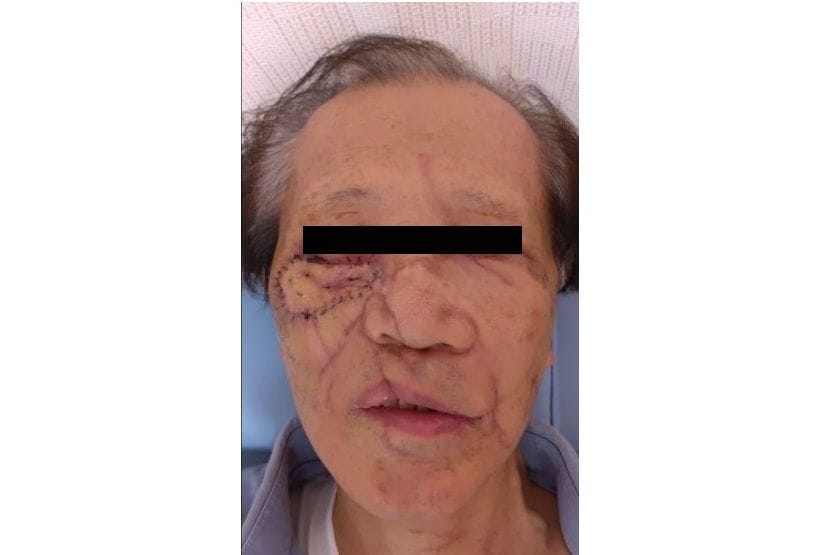 ランニング中に熊に襲われた男性（60代）。治療1カ月後の様子（写真：中永さん提供）