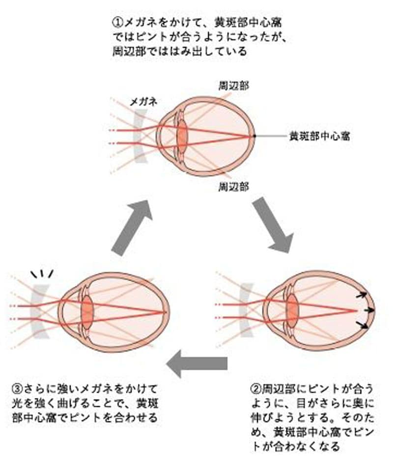メガネをかけても近視が進むわけ（『近視は病気です』より）