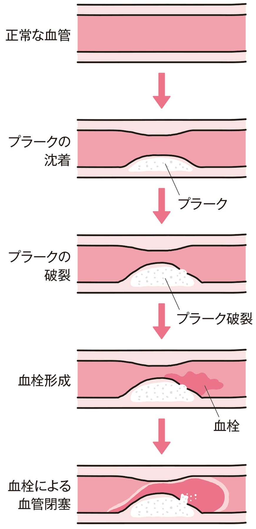 メタボの人に起こりやすい「動脈硬化」の進行を表した図。血管の内側に「プラーク」（かたまり）が生じ、血管が狭く、硬くなる。さらに「プラーク」が破裂すると、そこに血栓が生じて血管が詰まるリスクが高まる（図表『「100年心臓」のつくり方』より）