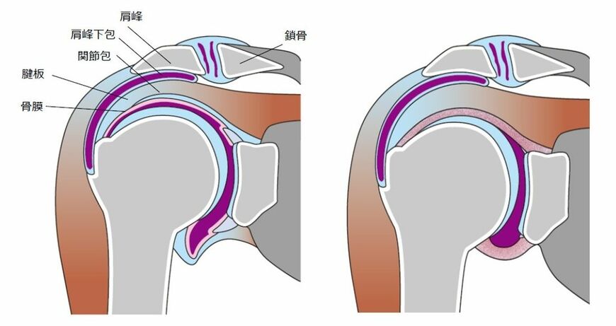 通常の肩関節（左）と凍結肩。正常な関節包（骨を覆う青い部分）には関節が動くための余裕があるが、凍結肩になると分厚く縮むため、関節が動かなくなる（イラスト：菅谷医師提供）