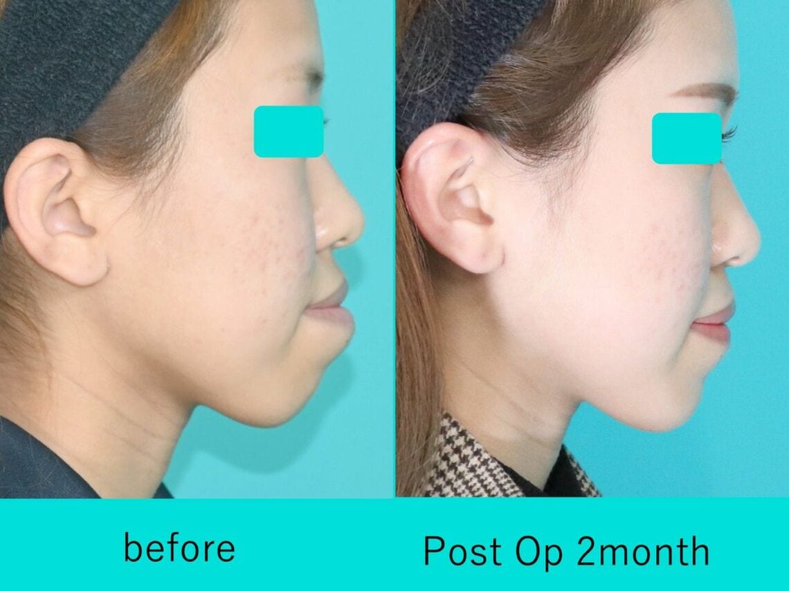 下顎の骨を切る受け口治療後の10代女性（写真：銀座マイアミ美容外科提供）