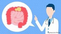 早期がんは内視鏡で切除 大腸がん｜高い診断力が求められる