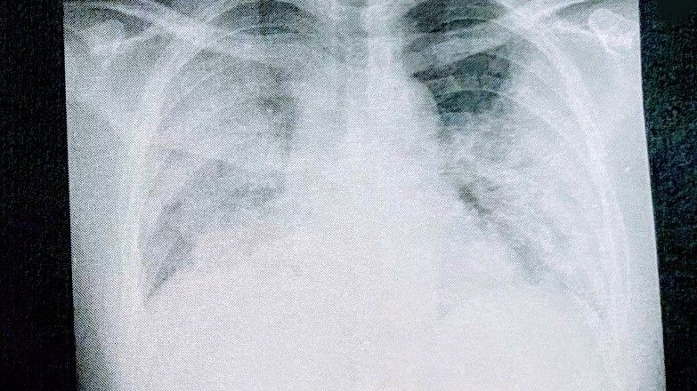 8月12日、入院した当日に撮った肺のレントゲン写真（写真：取材者提供）