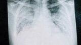 「もう助からない」専門家ですらそのように見えたほど真っ白になった肺。これが37歳のコロナ患者が味わった現実だ（写真：取材者提供）この記事の画像を見る(◯枚)