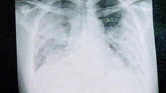 37歳｢肺が真っ白｣で死に瀕した彼の痛切な闘病記