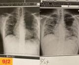 右・8月24日、東京1回目の入院で、退院2日前、左・9月2日、愛知県の病院で撮ったレントゲン写真（写真：取材者提供）