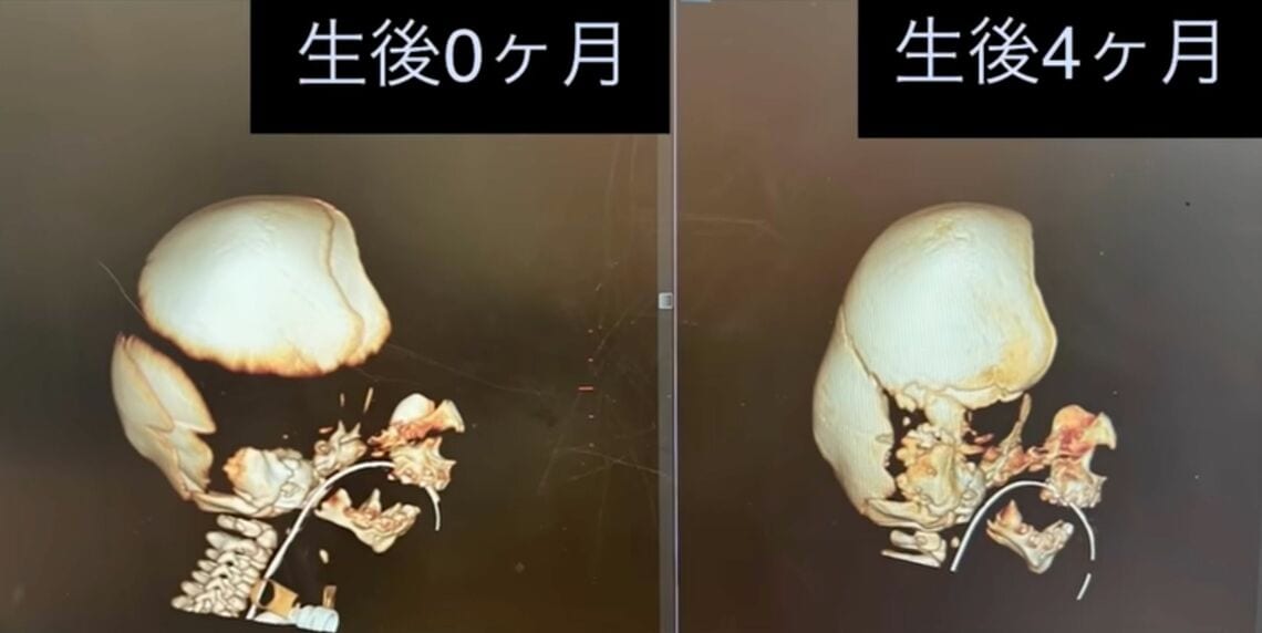 未来くんの頭蓋骨の変化。おでこ部分の頭蓋骨がないのがわかる（写真：両親提供）