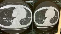 抗がん剤治療奏功も､予期せぬ体の異変とは？