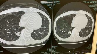抗がん剤治療奏功も､予期せぬ体の異変とは？