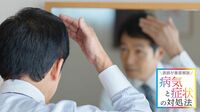【円形脱毛症】ストレスや心の弱さ原因ではない 偏見や誤解が多い病､2022年6月に治療薬が登場