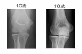 10歳と18歳の骨の違い。10歳ではまだ骨がしっかりできておらず、柔らかい（写真：古島さん提供）