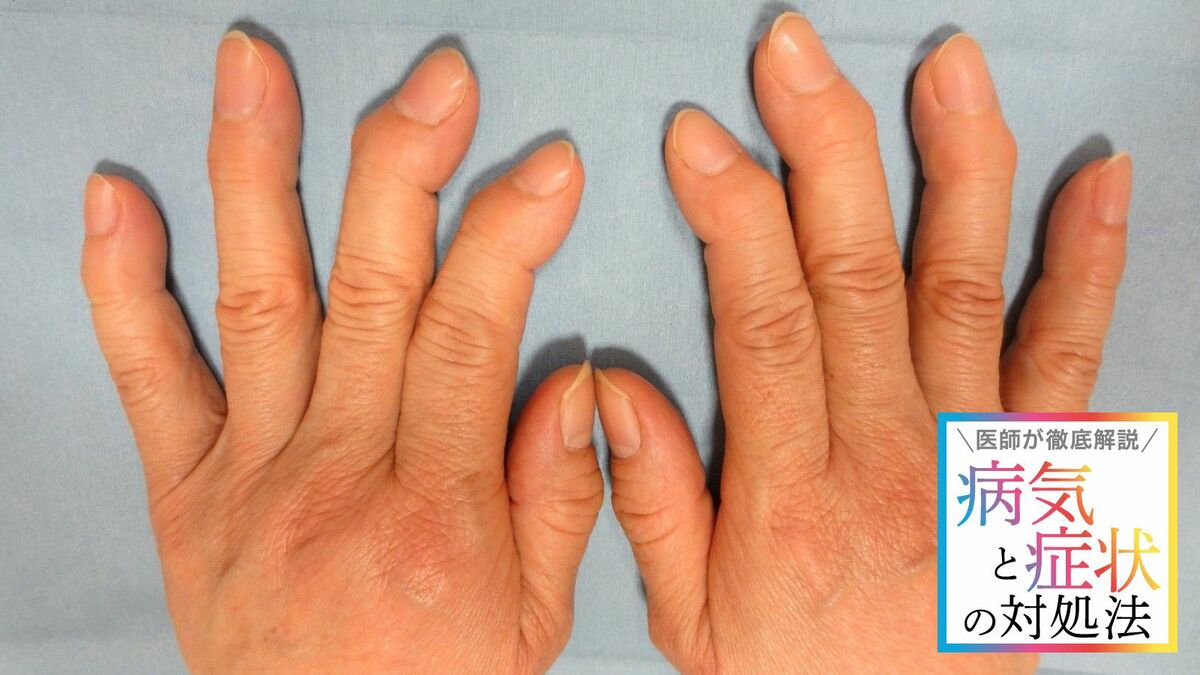 ｢手指の痛み･こわばり･変形｣リウマチとどう違う ｢考えられる病気6つと対策｣を専門家が解説 | ｢病気｣と｢症状｣の対処法 | 東洋経済オンライン